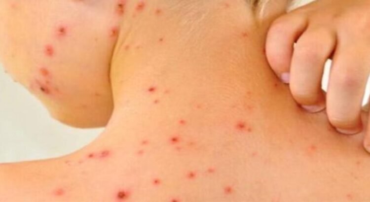 Aumentan casos de sarampión en Michoacán; van 22 enfermos y es la sexta a nivel nacional Aumentan casos de sarampión en Michoacán; van 22 enfermos y es la sexta a nivel nacional